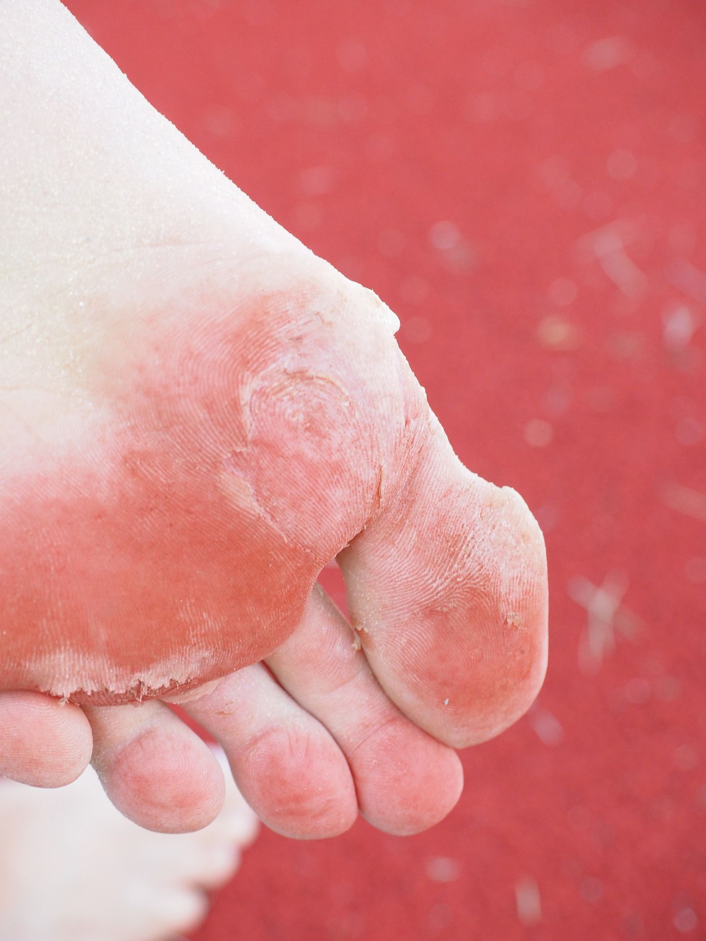 Grzybica stóp – przyczyny, objawy i leczenie